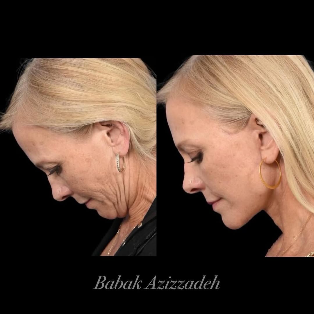 Instagram post by Dr. Babak Azizzadeh: 3 month follow-up after patient received deep plane facelift, neck lift and blepharoplasty! 😊 #facelift #deepplanefacelift #necklift