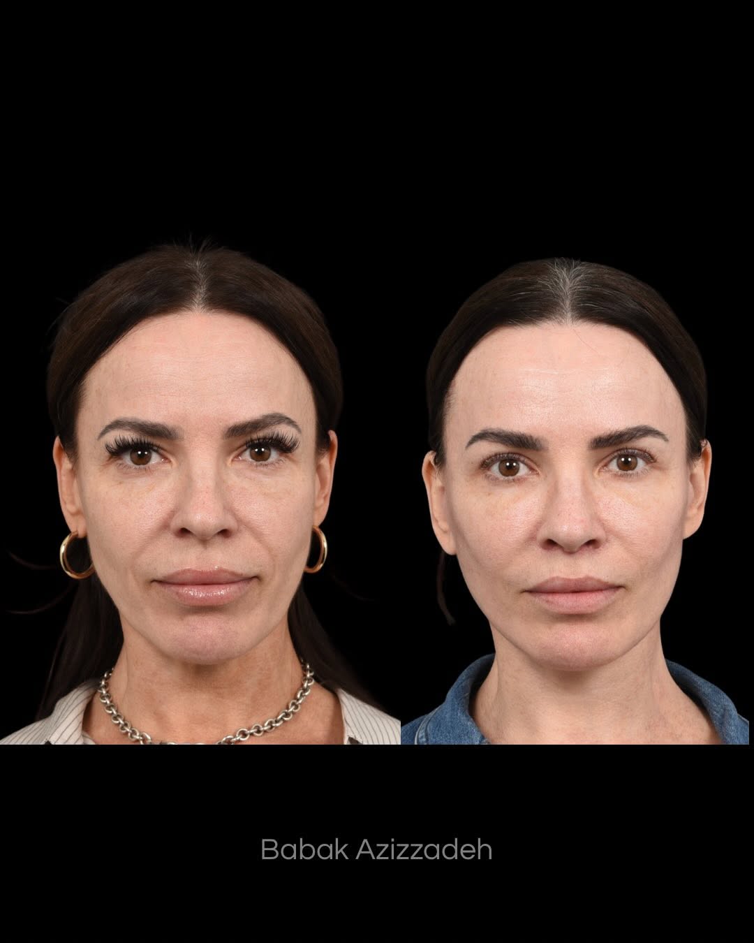 Instagram post by Dr. Babak Azizzadeh: Age 46 3 months post-op This patient wanted to look how she feels on the inside, so our goal was to create a refreshed, elevated version of …