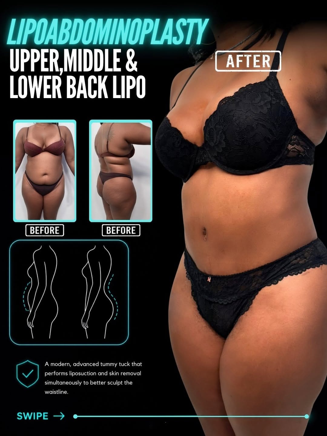 Instagram post by Dr. Babak Moeinolmolki: Lipoabdominoplasty + Back Liposuction ✨ A flatter abdomen and a more sculpted back can completely transform your overall silhouette. BEFORE …