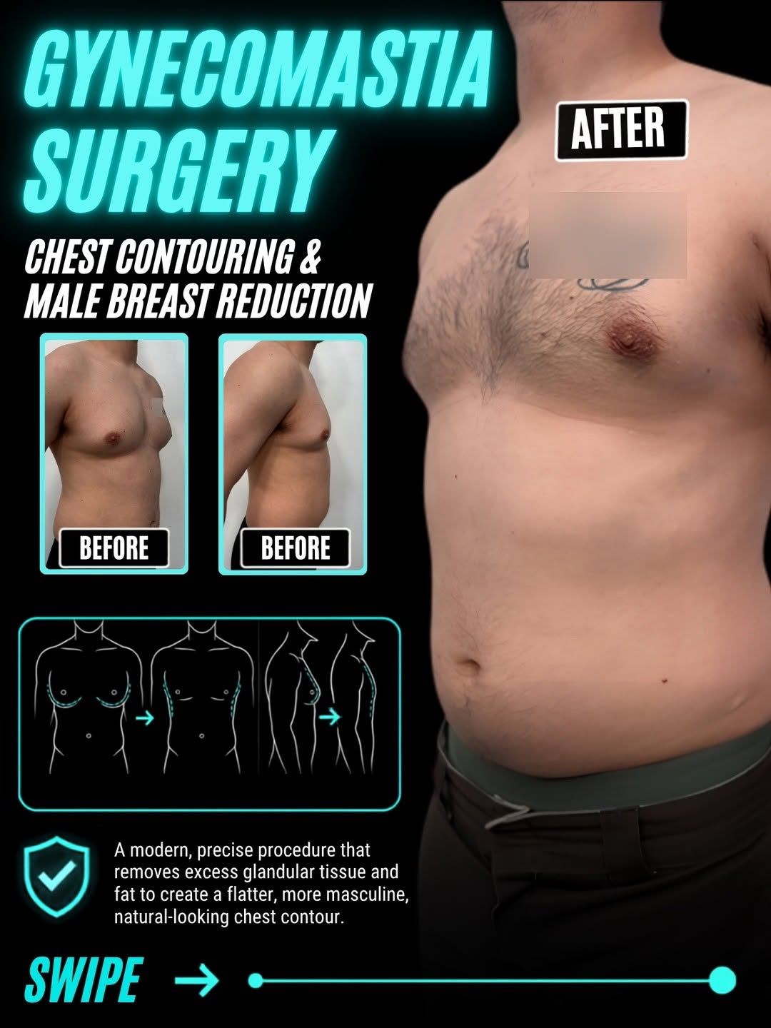 Instagram post by Dr. Babak Moeinolmolki: NO MORE PUFFY CHEST. JUST A STRONGER LOOK. 🔥 Behind the scenes of Gynecomastia Surgery, designed specifically for men looking to reduce exc…