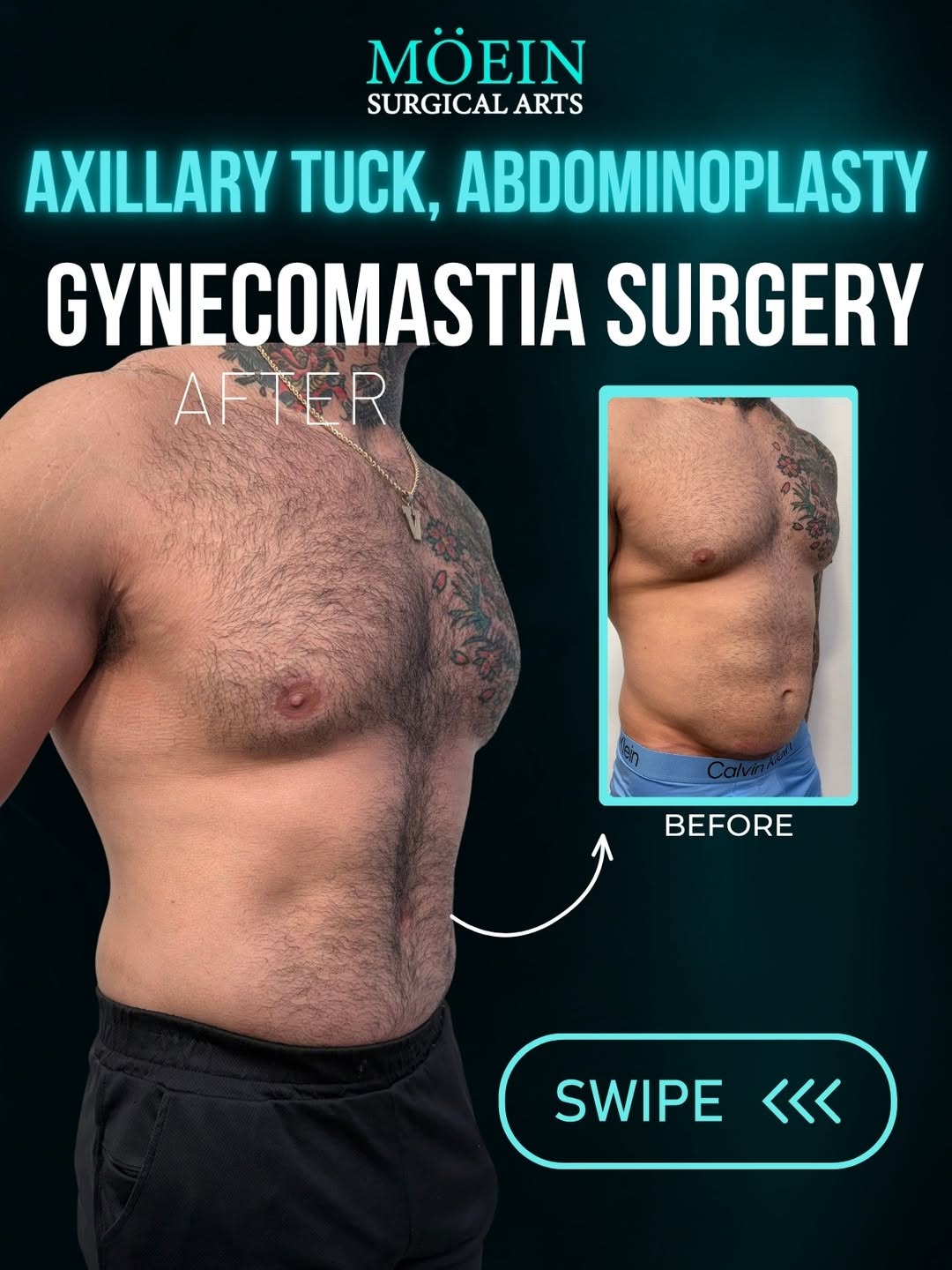 Instagram post by Dr. Babak Moeinolmolki: Axillary Tuck + Gynecomastia Surgery + Abdominoplasty ✨ A more sculpted chest, smoother underarms, and a tighter core can completely transfo…
