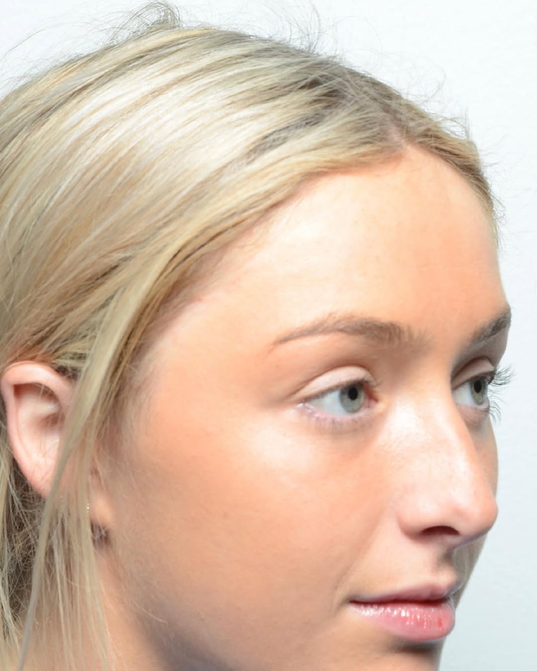 Instagram post by Dr. Babar Sultan: It was great to follow up with my patient after her finesse rhinoplasty. Subtle changes can go a long way. Swipe left to see the before/afte…