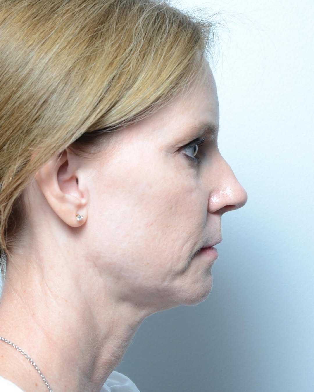 Instagram post by Dr. Babar Sultan: It was great seeing my patient in follow up after her deep plane lower face/neck lift. We are loving the natural but meaningful outcome. Swi…