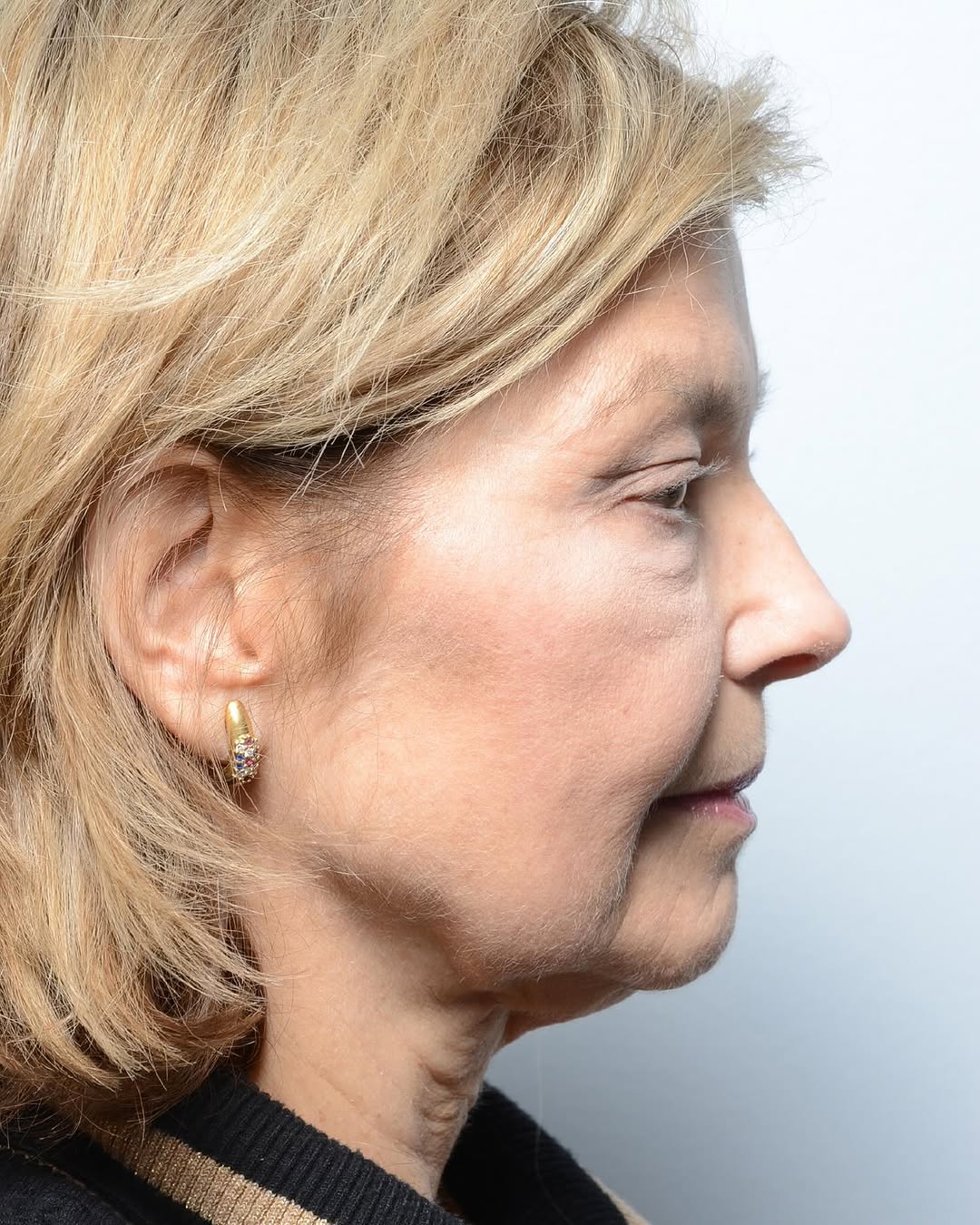 Instagram post by Dr. Babar Sultan: I just saw my lovely patient after a deep plane lower face/necklift. I love how natural but significant the change is to the jawline. Pls sw…