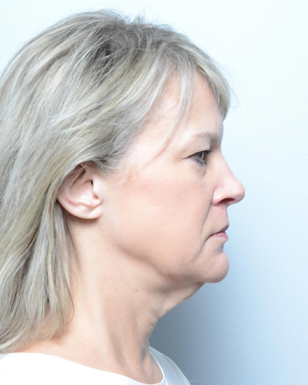 Instagram post by Dr. Babar Sultan: This lovely patients underwent a deep plane lower face/necklift only 7 days ago by Dr. Sultan. Swipe left to see her early result. #facelift…