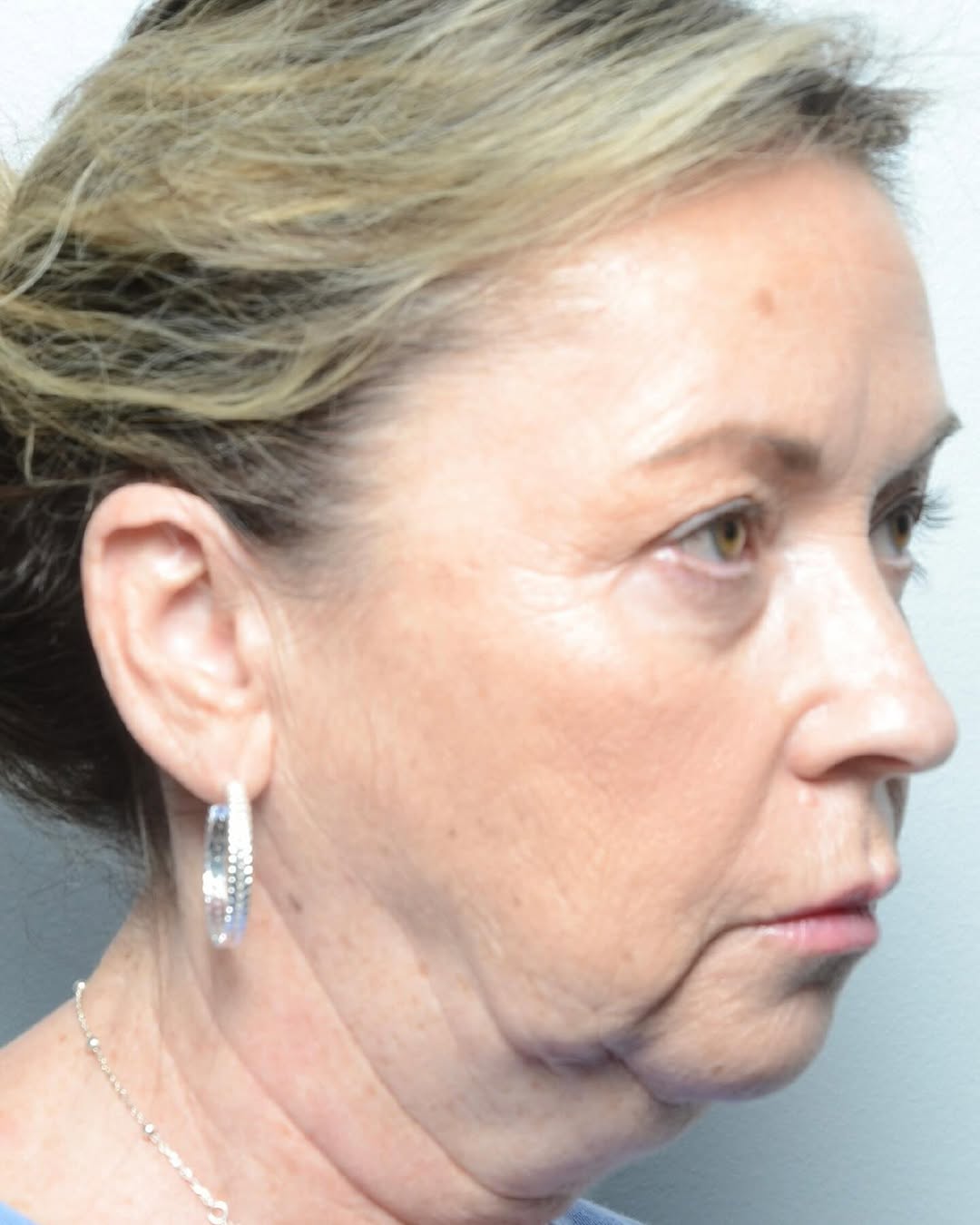 Instagram post by Dr. Babar Sultan: This lovely patient underwent a deep plane lower face/neck lift with chin implant by Dr. Sultan. Pls swipe to see the after and other views.…