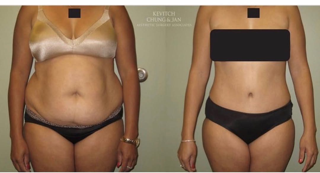 Instagram post by Dr. Badar Jan: #tummytuck#beforeandafter#cosmeticsurgery#lehighvalley