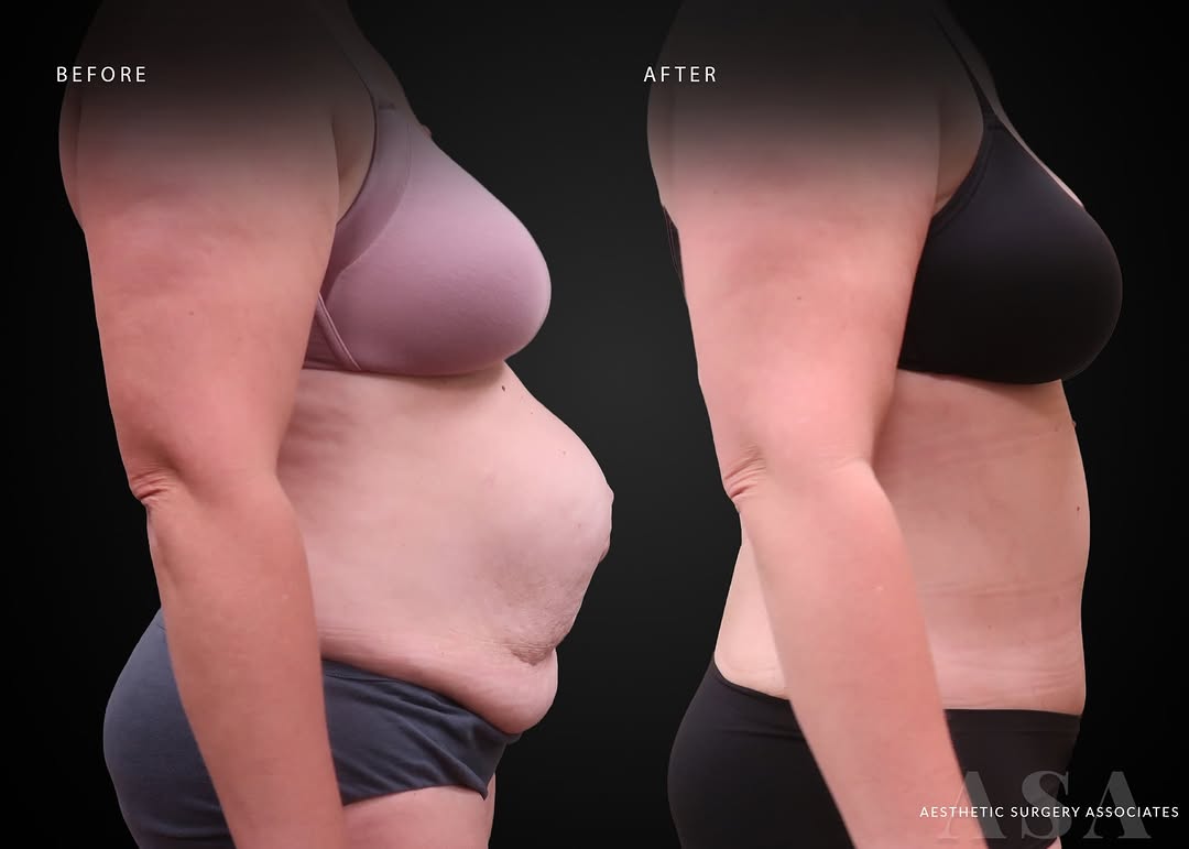 Before and after abdominoplasty with lipo 360, umbilical hernia repair, and diastasis recti. Lehigh Valley, PA Aesthetic Surgery Associates, Board Certified Plastic Surgeons