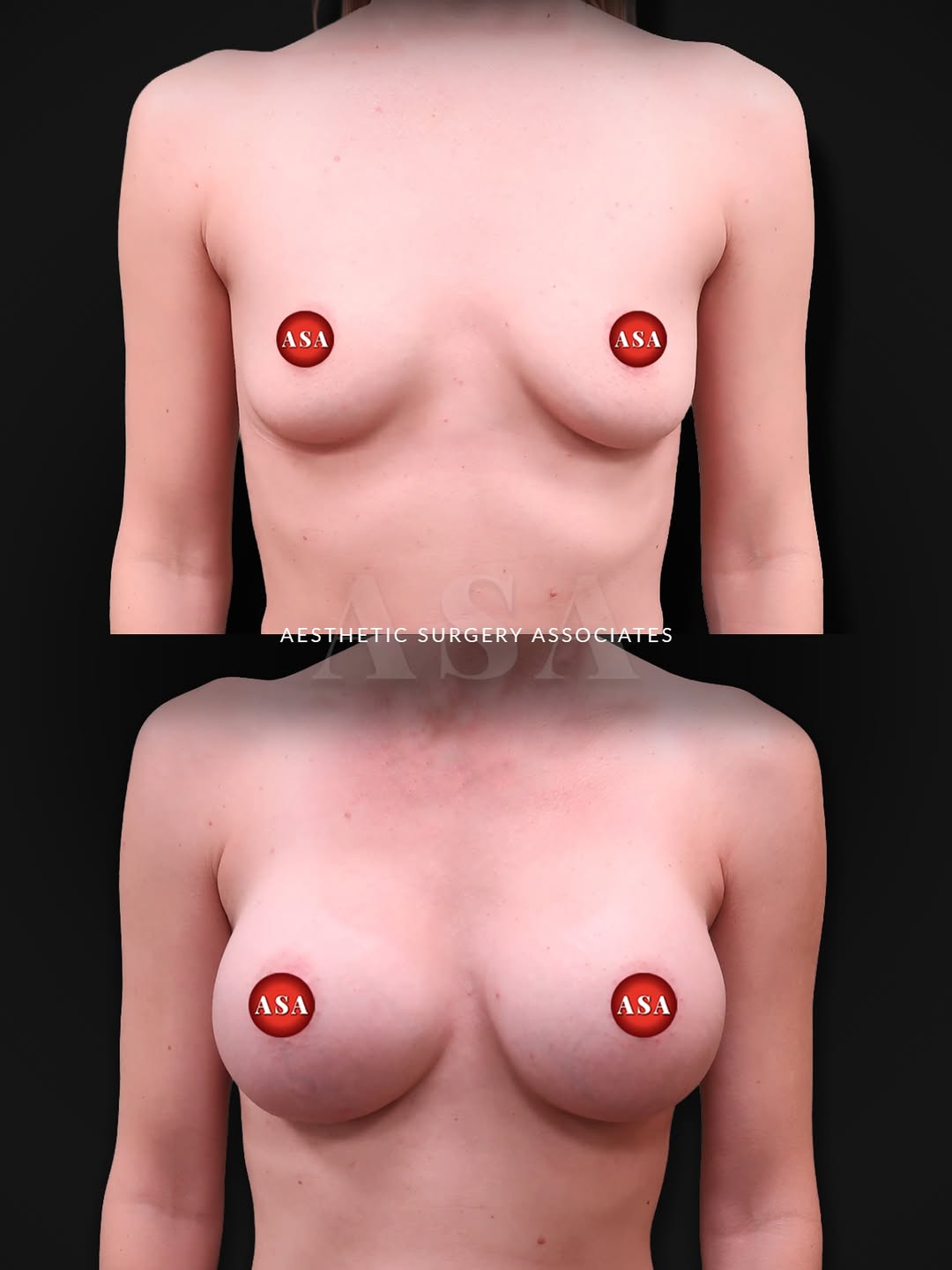 450cc Before and After HP Silicone Implants Dr. Badar Jan at Aesthetic Surgery Associates Lehigh Valley, PA