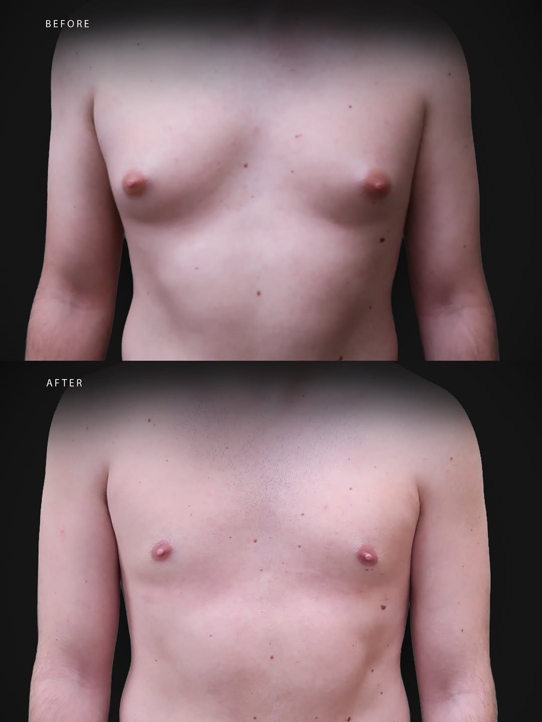 1 year post gynecomastia at Aesthetic Suegery Associates in Lehigh Valley, PA
