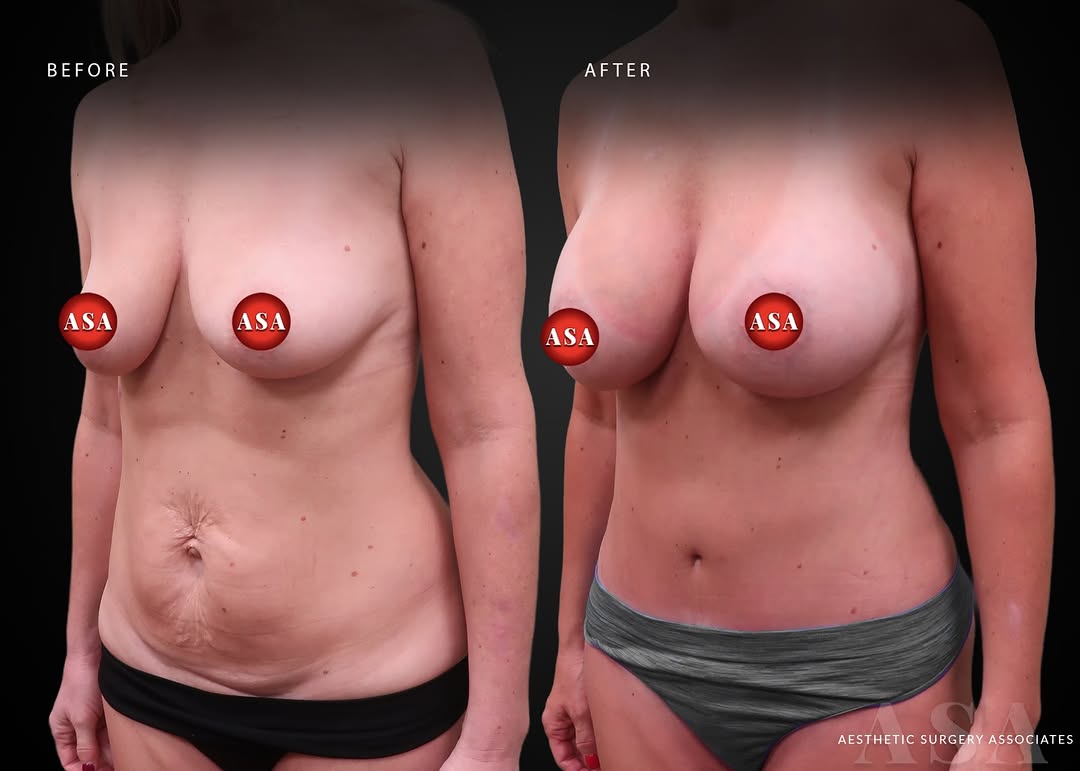 Mommy makeover in Pennsylvania board certified plastic surgeon Philly surgeon