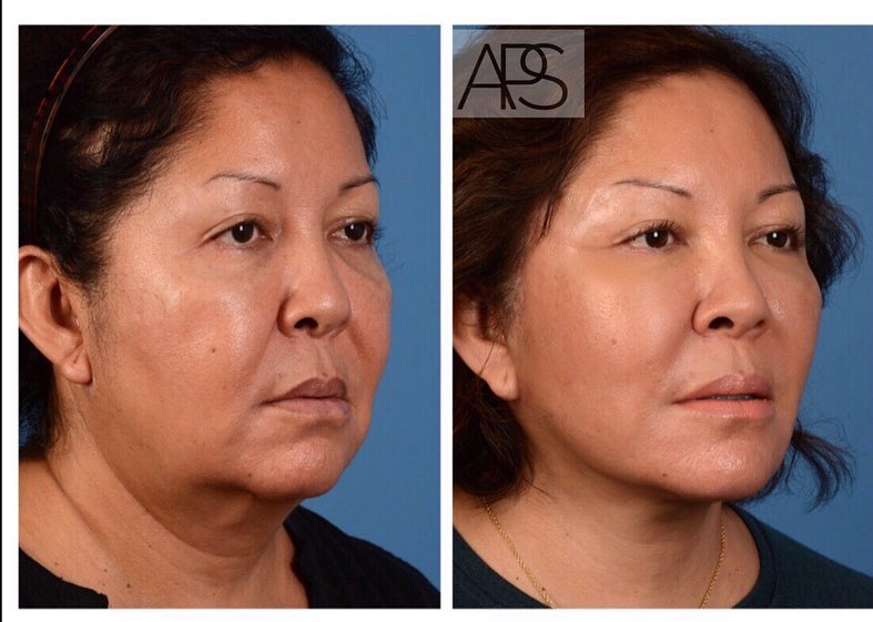 Instagram post by Dr. Bardia Amirlak: “A well contoured neck and jaw line is an artistic essential to an attractive face. It represents youth, health, decisiveness and sensuality…