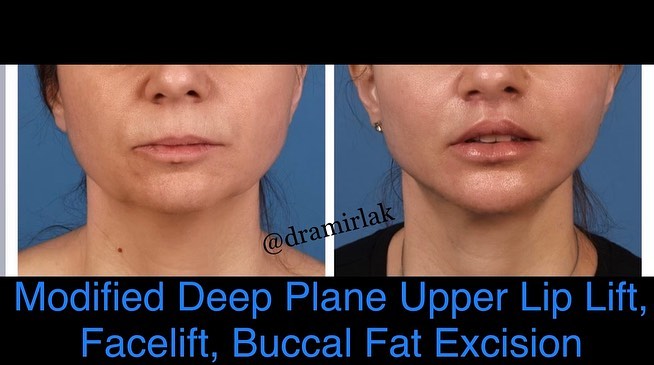 Instagram post by Dr. Bardia Amirlak: The ultimate facial plastic surgery package is completed with our Modified Deep Plane Upper Lip Lift. No facelift will be fully successful i…