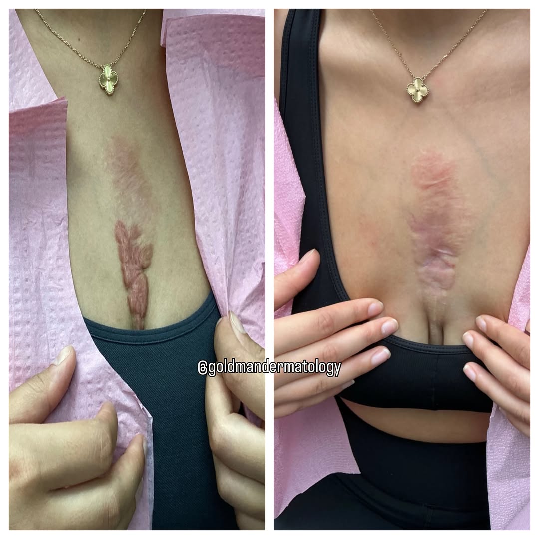 Instagram post by Dr. Barry D. Goldman: Keloid before and after. In this case, we used a combination of injections and laser to flatten this initial rock hard keloid scar in a youn…