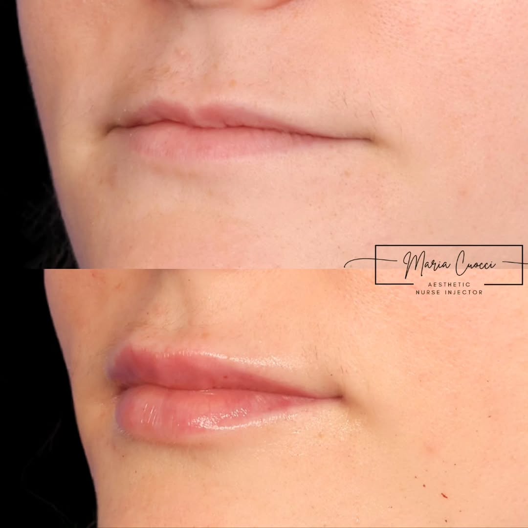 Instagram post by Dr. Barry E. DiBernardo: From small lips to a perfect pout with RHA2 💋 Lip filler allowed for enhancement and balance to to her lower face, all while staying natura…