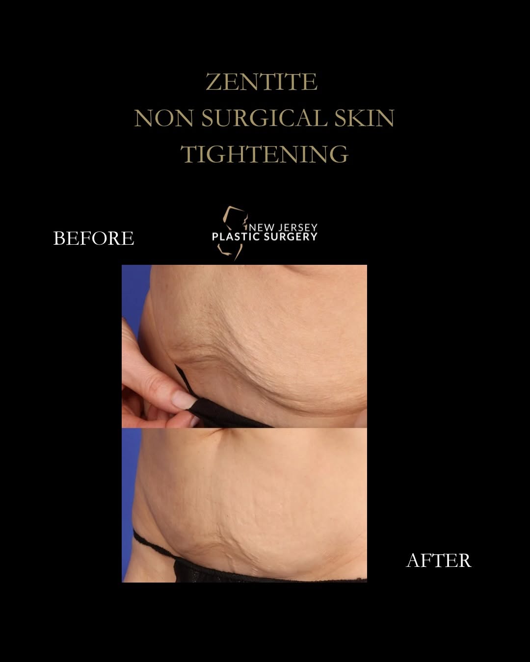 Loose abdominal skin, meet Zentite. 👏
This before + after shows the improvement in skin laxity following Zentite non-surgical skin tightening of the abdomen. No surgery, just a firmer, smoother-look