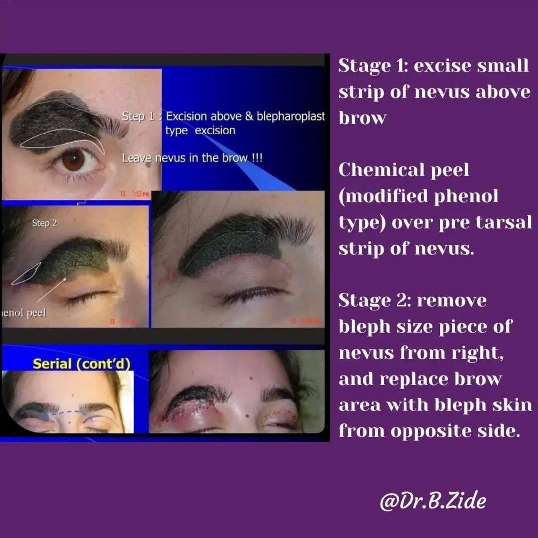 Instagram post by Dr. Barry M. Zide: #nevus #nevusoutreach #nevuslove #nevususa #nevusespanol #nevusbrazil #nevuschile #beautymark #beautymarkcommunity #facialreconstruction #pl…