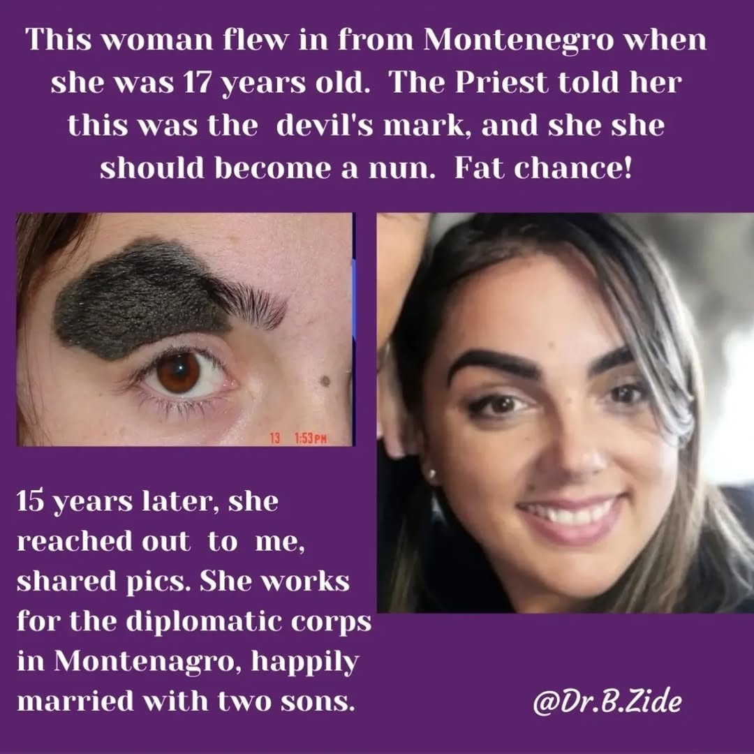 Instagram post by Dr. Barry M. Zide: #nevus #nevusoutreach #nevuslove #nevususa #nevusespanol #nevusbrazil #nevuschile #beautymark #beautymarkcommunity #facialreconstruction #pl…