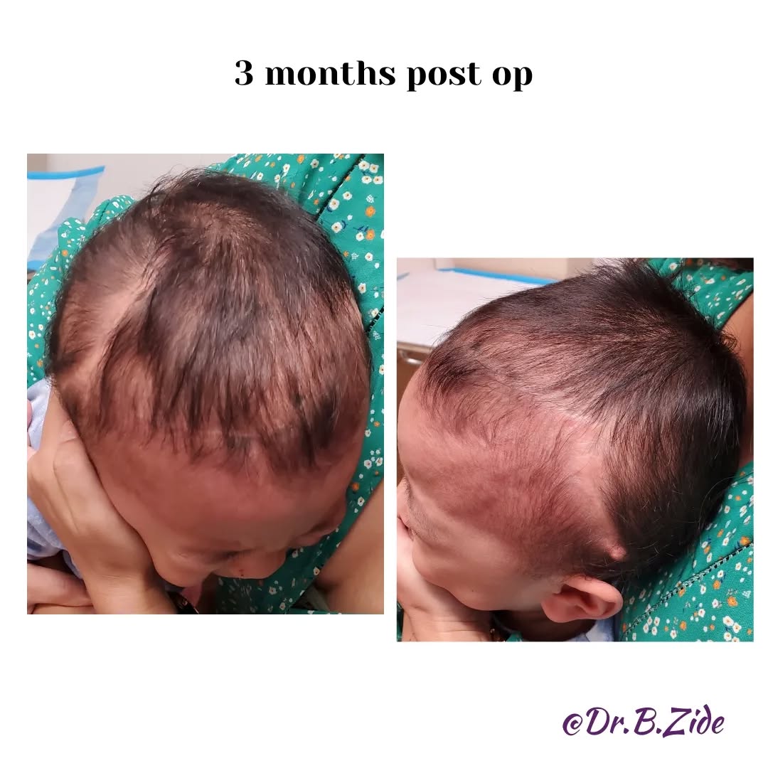 Instagram post by Dr. Barry M. Zide: Precious child. #nevus #nevusoutreach #nevuslove #nevususa #nevusespanol #nevusbrazil #nevuschile #beautymark #beautymarkcommunity #facialre…