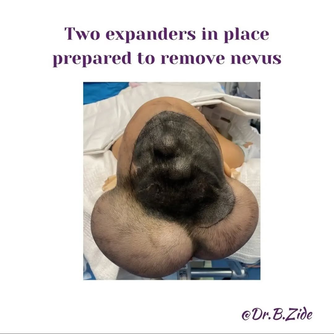 Instagram post by Dr. Barry M. Zide: #nevus #nevusoutreach #nevuslove #nevususa #nevusespanol #nevusbrazil #nevuschile #beautymark #beautymarkcommunity #facialreconstruction #pl…