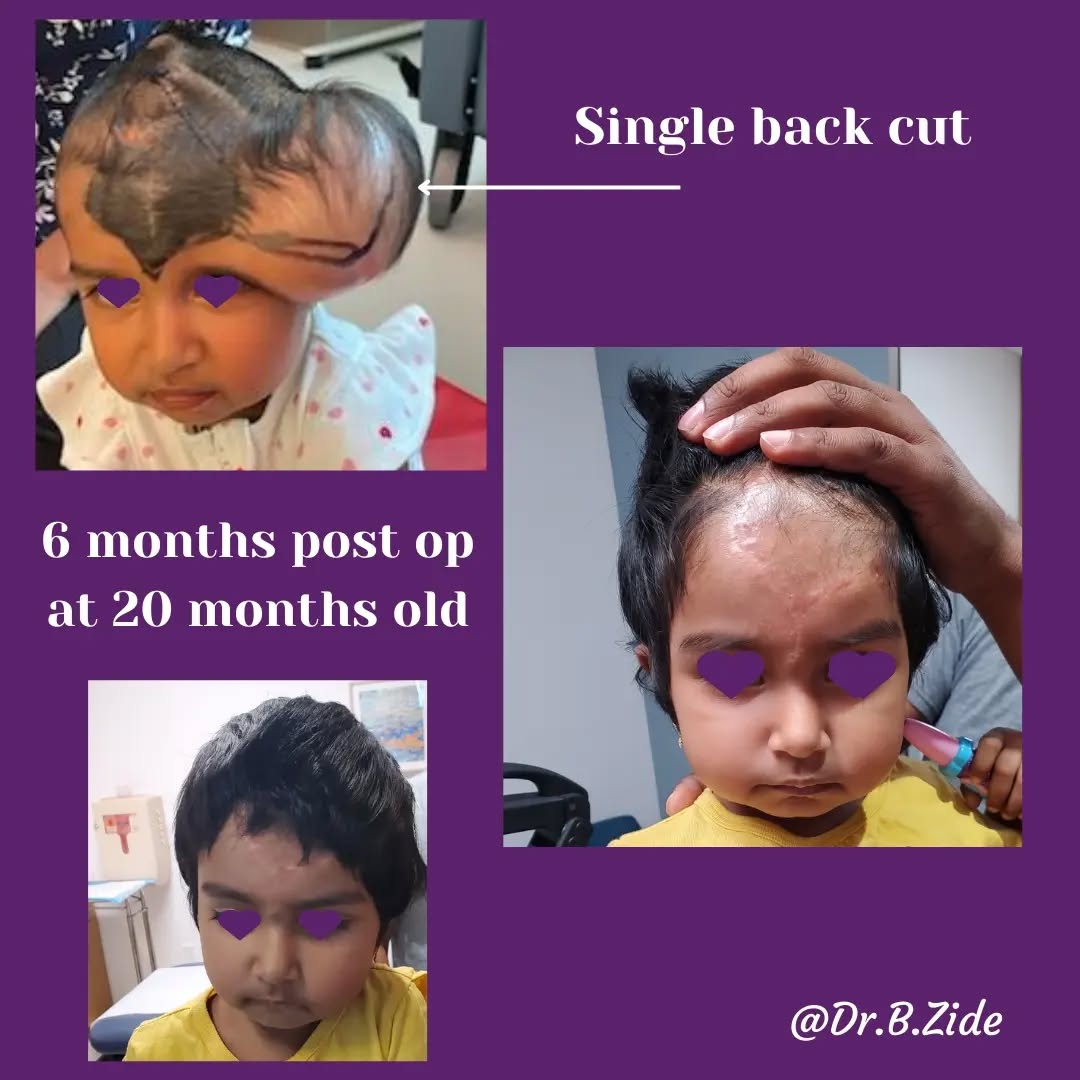 Instagram post by Dr. Barry M. Zide: #nevus #nevusoutreach #nevuslove #nevususa #nevusespanol #nevusbrazil #nevuschile #nevusnepal #facialreconstruction #plasticsurgeon #doctor …