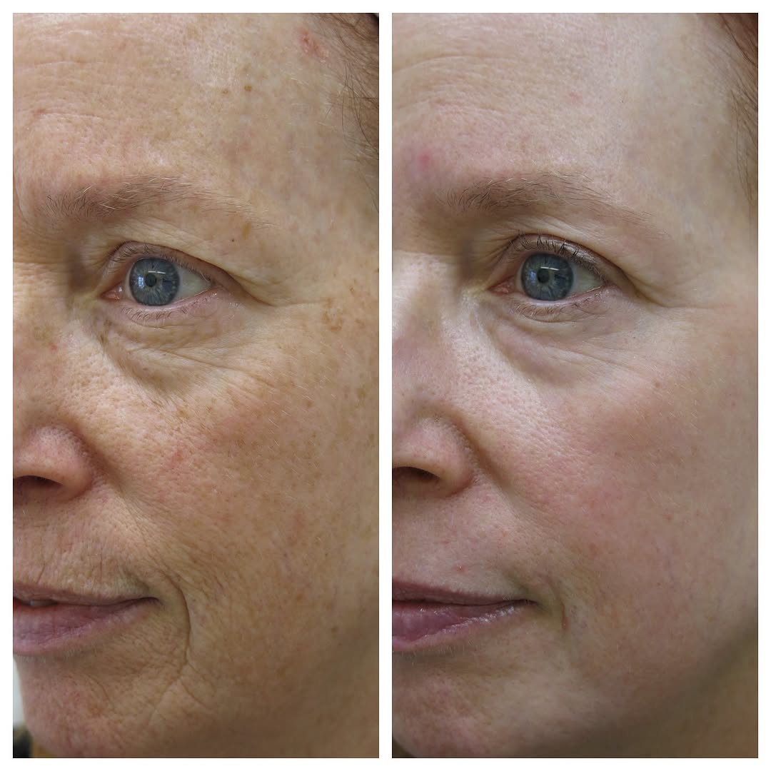 Instagram post by Dr. Barton Sterling: Take back your youth with a Chemical Peel by Dr. Sterling ✨ Call to schedule your consultation today (732)449-3005 #americanacademyofdermato…