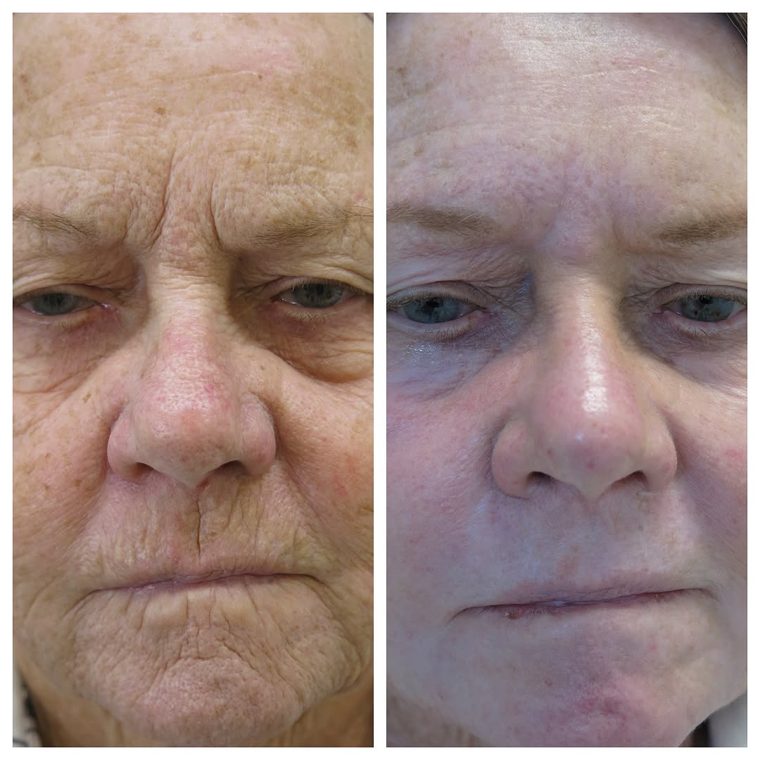 Instagram post by Dr. Barton Sterling: Turning back time with a Chemical Peel by Dr. Sterling! @dr.sterling.md #americanacademyofdermatology#dermatology#skincare#chemicalpeel#anti…