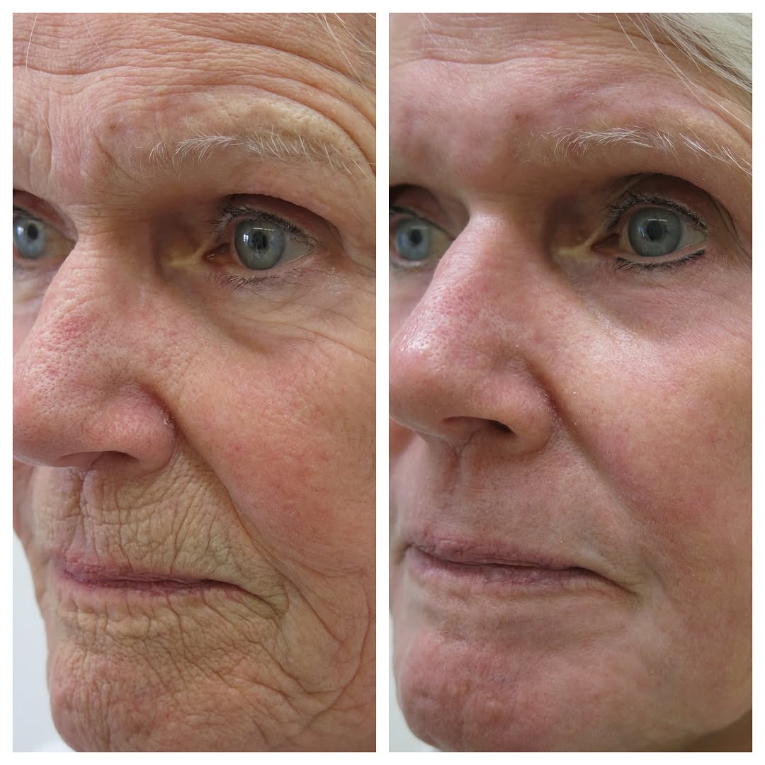 Instagram post by Dr. Barton Sterling: Wow!! Look at these beautiful results from a Chemical Peel by Dr. Sterling! Call to schedule a peel consultation today (732)449-3005 #americ…