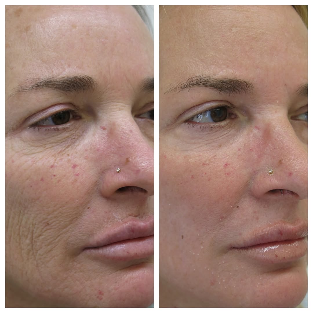 Instagram post by Dr. Barton Sterling: Look at these amazing results from a Chemical peel including upper lip scar correction! Do you have wrinkles, saggy skin, scars, or age spot…