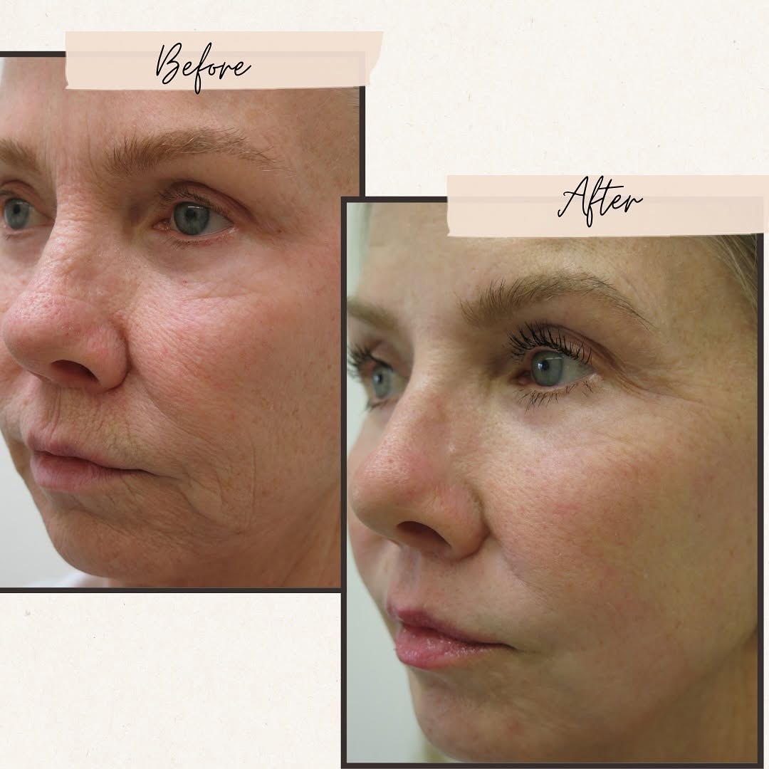 Instagram post by Dr. Barton Sterling: Wow! Look at these beautiful results from a Chemical Peel by Dr. Sterling! Are you ready to look more youthful? Give our office a call to sc…