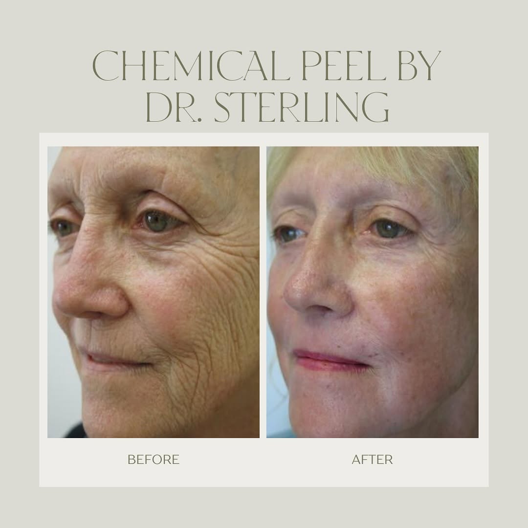 Instagram post by Dr. Barton Sterling: Turning back time with a Chemical Peel by Dr. Sterling! What are you waiting for? Call 732-449-3005 to schedule your consultation today. @dr…