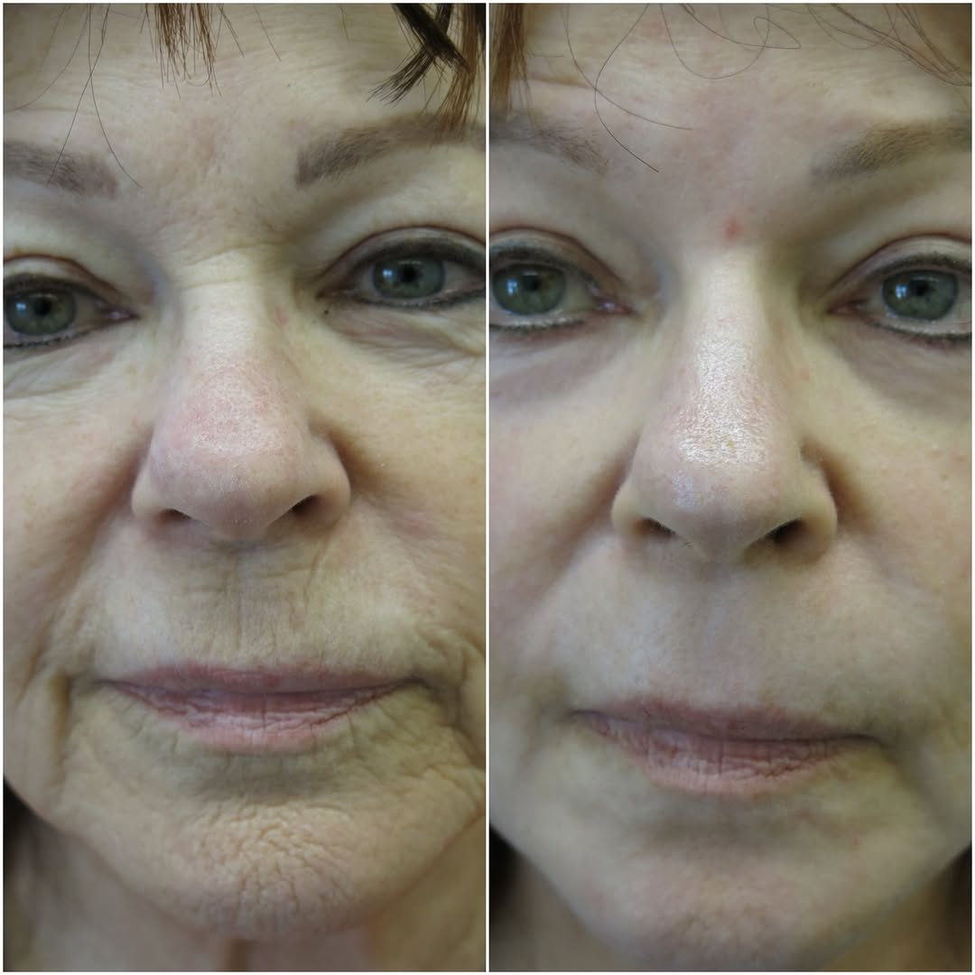 Instagram post by Dr. Barton Sterling: Incredible transformation after a Chemical Peel with Dr. Sterling! Schedule your consultation today (732)449-3005 @dr.sterling.md