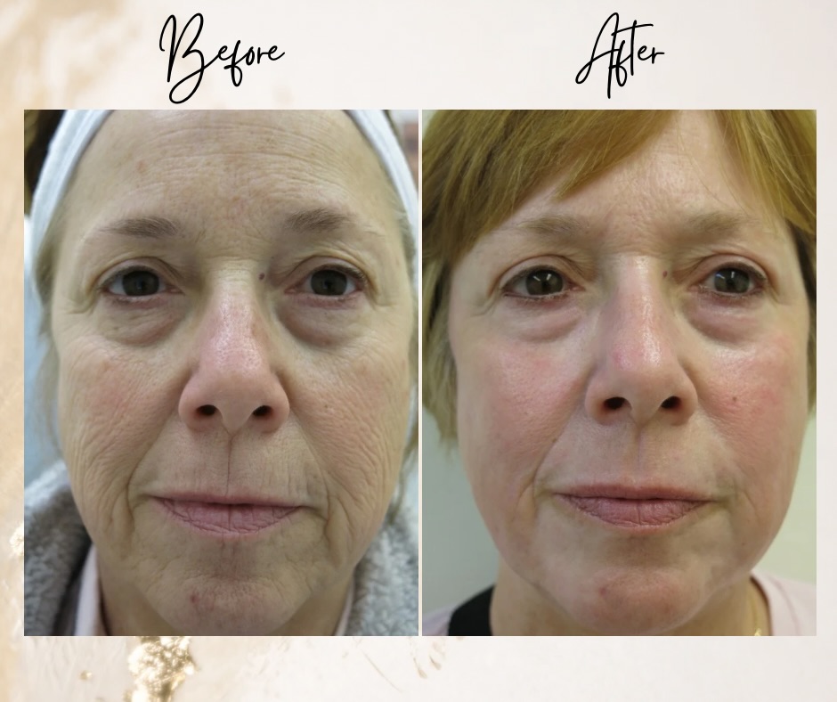 Instagram post by Dr. Barton Sterling: Before➡️After Chemical Peel by Dr. Sterling She was one happy patient! 7324493005