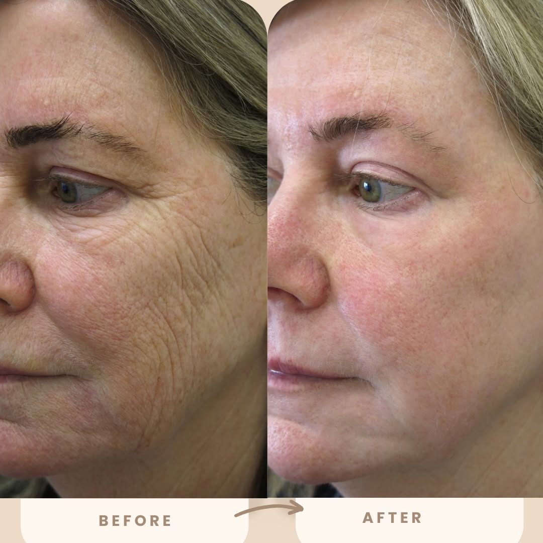 Instagram post by Dr. Barton Sterling: Look at these beautiful results from a Chemical Peel by Dr. Sterling! Chemical peels are the ultimate way to smooth texture and reveal fresh…