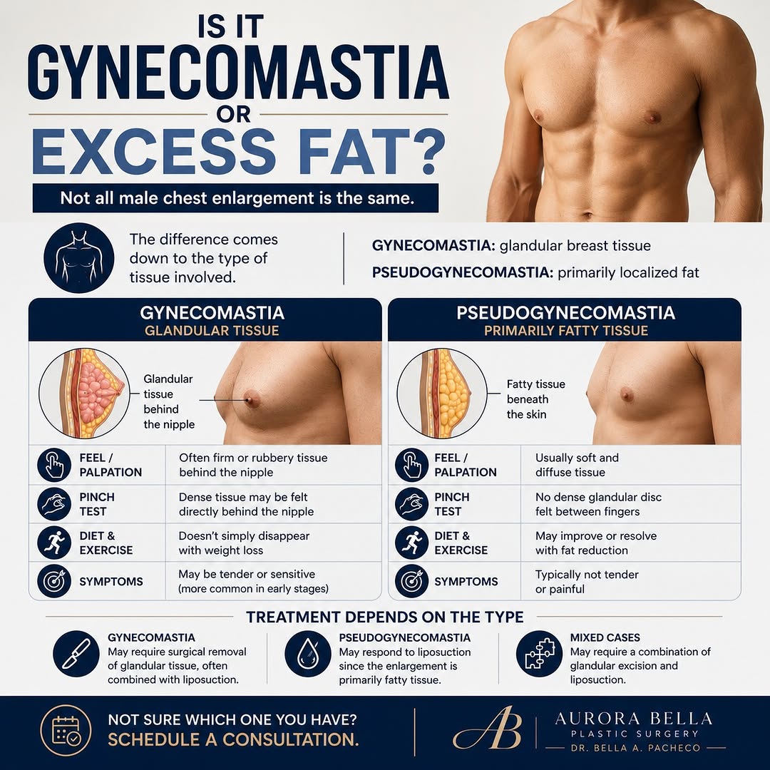 Instagram post by Dr. Bella A. Pacheco: Is It Gynecomastia or Excess Fat? Not all male chest enlargement is the same. Understanding the difference between gynecomastia and pseudogy…