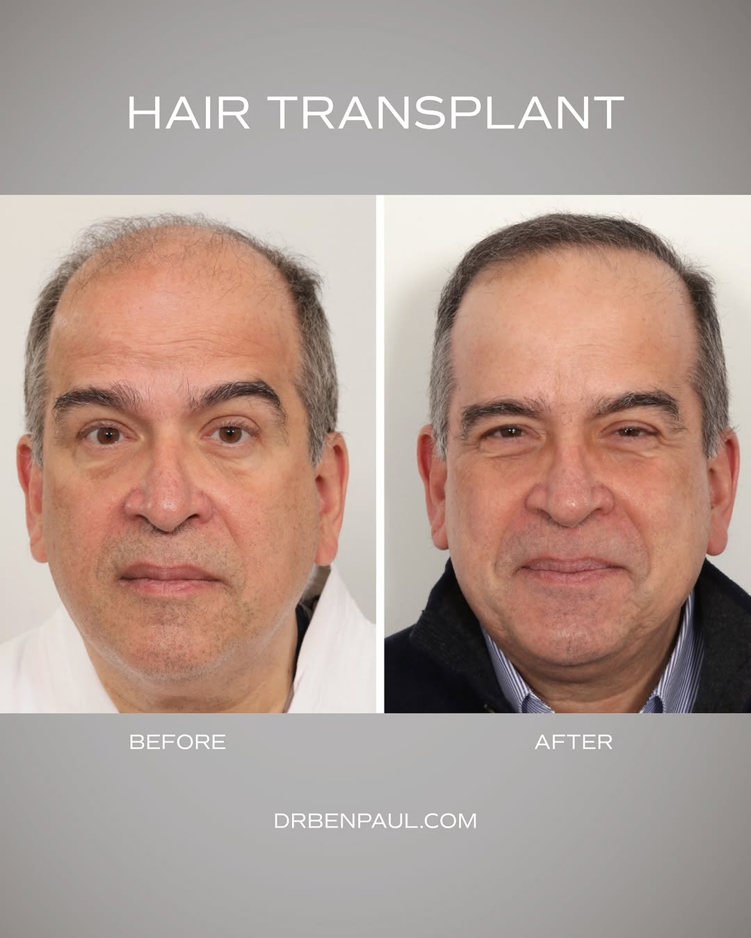 Instagram post by Dr. Benjamin C. Paul: One year after his male hair transplant, the goal was to improve facial framing at the front of his head and create a result that read as na…