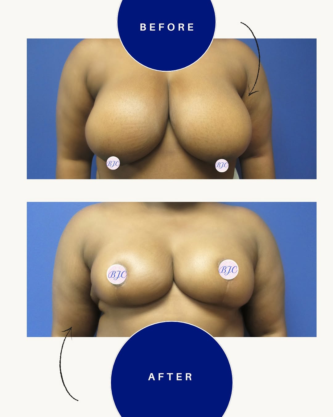 Instagram post by Dr. Benjamin J. Cousins: A beautiful transformation ✨ This lovely patient underwent a bilateral inferior pedicle breast reduction, achieving the natural yet dramatic…
