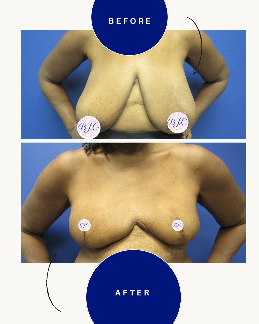 Instagram post by Dr. Benjamin J. Cousins: This inspiring 70-year-old patient has a history of bilateral breast cancer. Following bilateral mastectomies performed by her oncologic sur…
