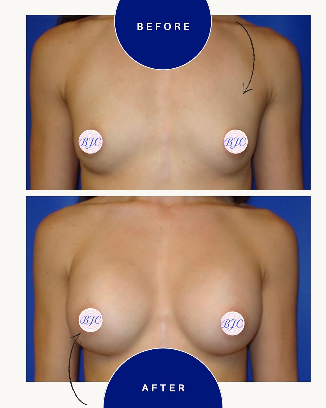 Instagram post by Dr. Benjamin J. Cousins: This 26-year-old patient has a history of cardiac surgery and a midline sternum incision from early childhood. She underwent bilateral breas…