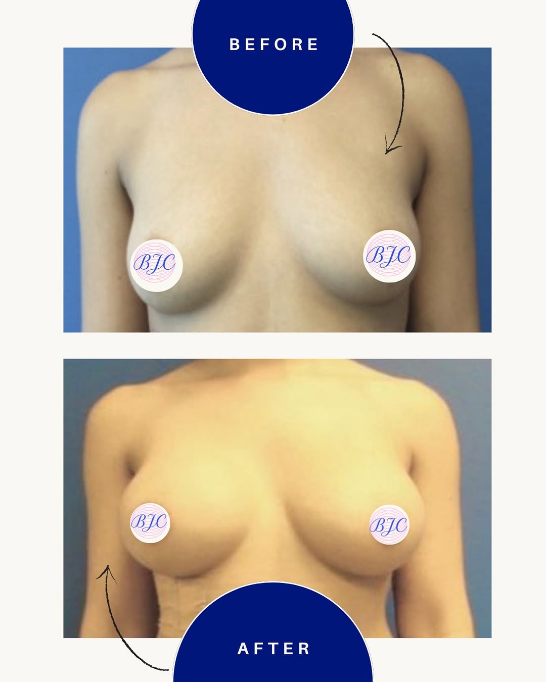 Instagram post by Dr. Benjamin J. Cousins: #throwbackthursday ⭐️ This 23 y/o patient underwent a bilateral breast augmentation with placement of 350cc gel @tigeraestheticsmedical impl…