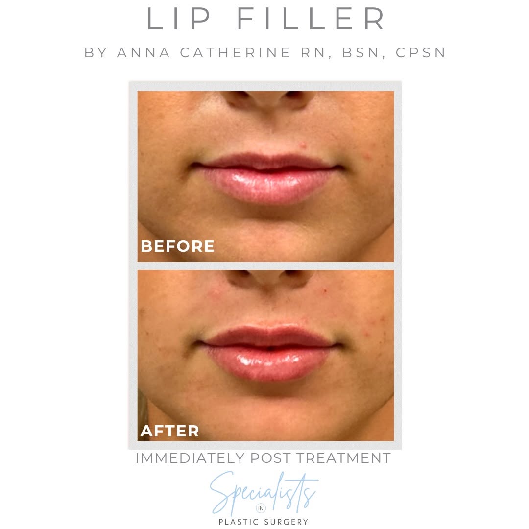 Instagram post by Dr. Benjamin Wood: New season, new pout 🍂💋 Fall is officially in the air and what better time for a little refresh? ✨ The subtle lip filler transformation is…