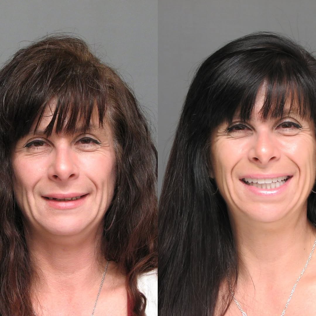 Instagram post by Dr. Bernard Ian Krupp, DDS: Beautiful results. This could be just what you need for a new year and new beginning. Visit KRUPP CENTER.com or call 410 -583–7600 to begin …