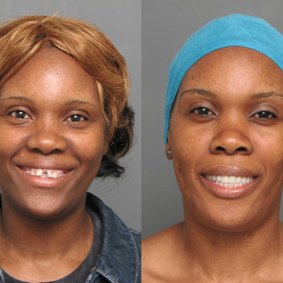 Instagram post by Dr. Bernard Ian Krupp, DDS: Stunning Smile! Dr. Krupp and our Team are happy to make this a reality for you. Contact us today to begin your transformation. 410-583-7600…
