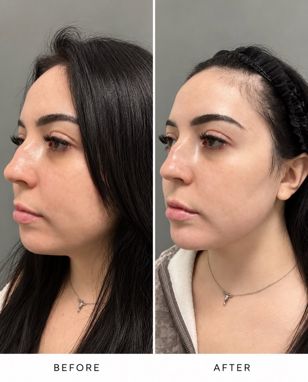 Instagram post by Dr. Bernard Raskin: Subtle structure. Beautiful definition. Still completely her. ✨ These Radiesse jawline filler results are the perfect example of how the rig…