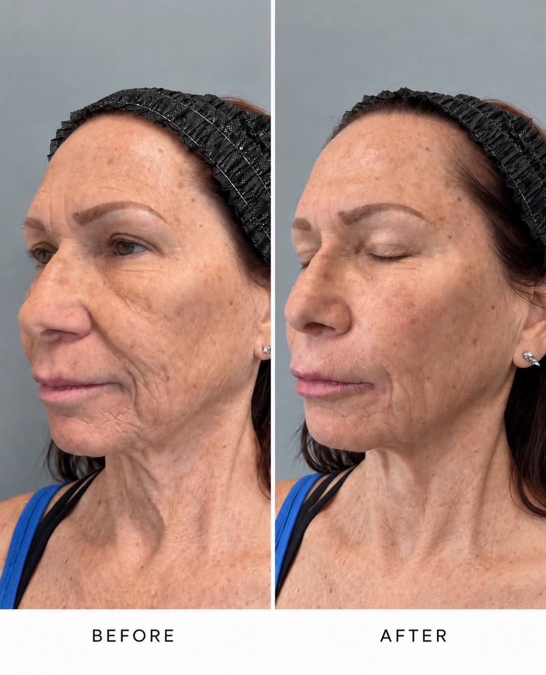 Instagram post by Dr. Bernard Raskin: This is what full facial balancing is supposed to look like: completely natural, just so much better. ✨ Dr. Shawn strategically restored vol…