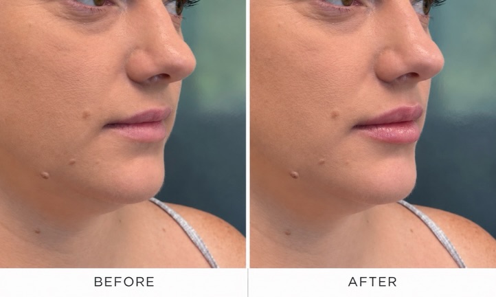 Instagram post by Dr. Bernard Raskin: Lip filler should look like you, just more balanced. 💋 For this patient, we added soft, strategic volume to enhance her natural lip shape, …
