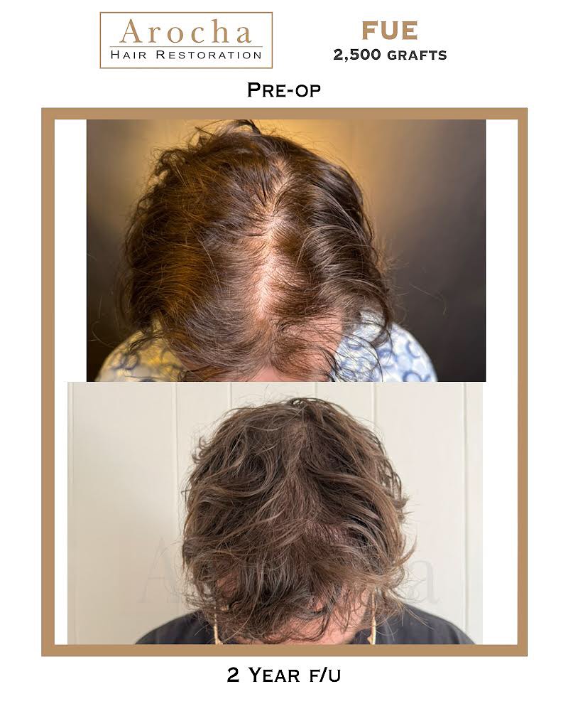 Instagram post by Dr. Bernardino Arocha: Two years post-op and the results speak for themselves. This patient underwent a 2500 graft FUE procedure with PRP, with Dr. Arocha and team…