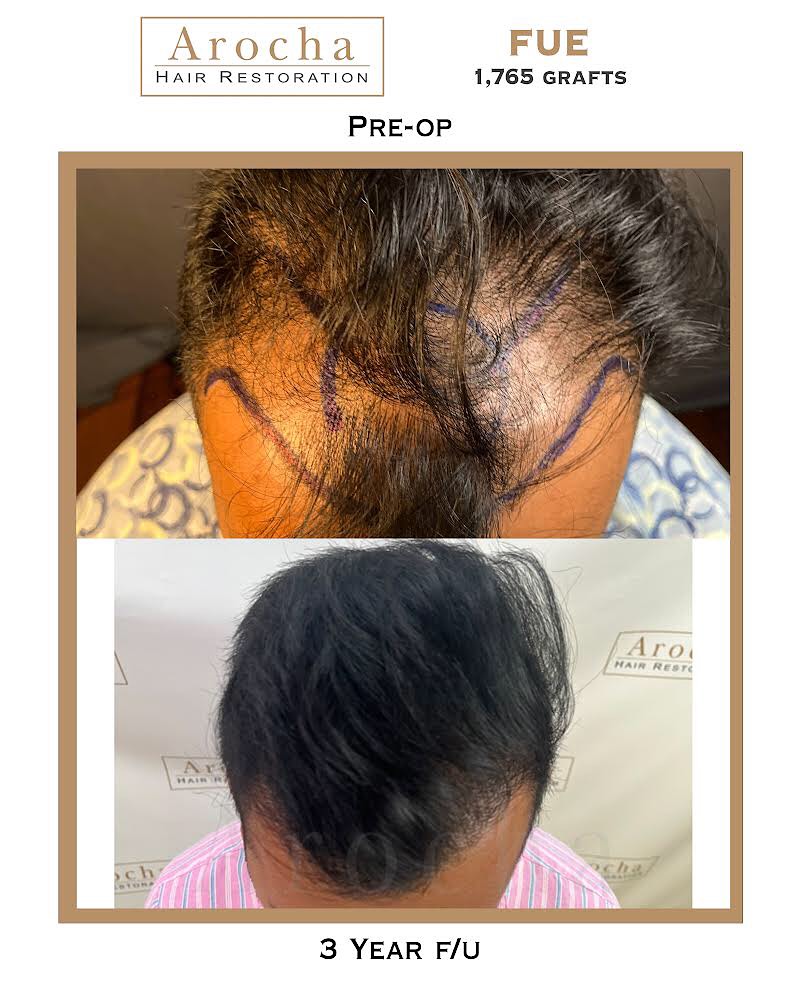 Instagram post by Dr. Bernardino Arocha: Three years later after a hair transplant with Dr. Arocha and the results speak for themselves. This patient underwent an FUE procedure that…