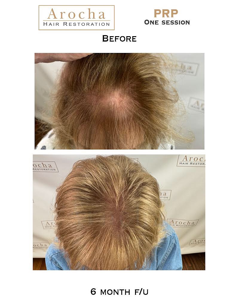Instagram post by Dr. Bernardino Arocha: This patient is 6 months out from her single PRP session. Swipe to see the natural transformation! In just one session, she was able to gain…
