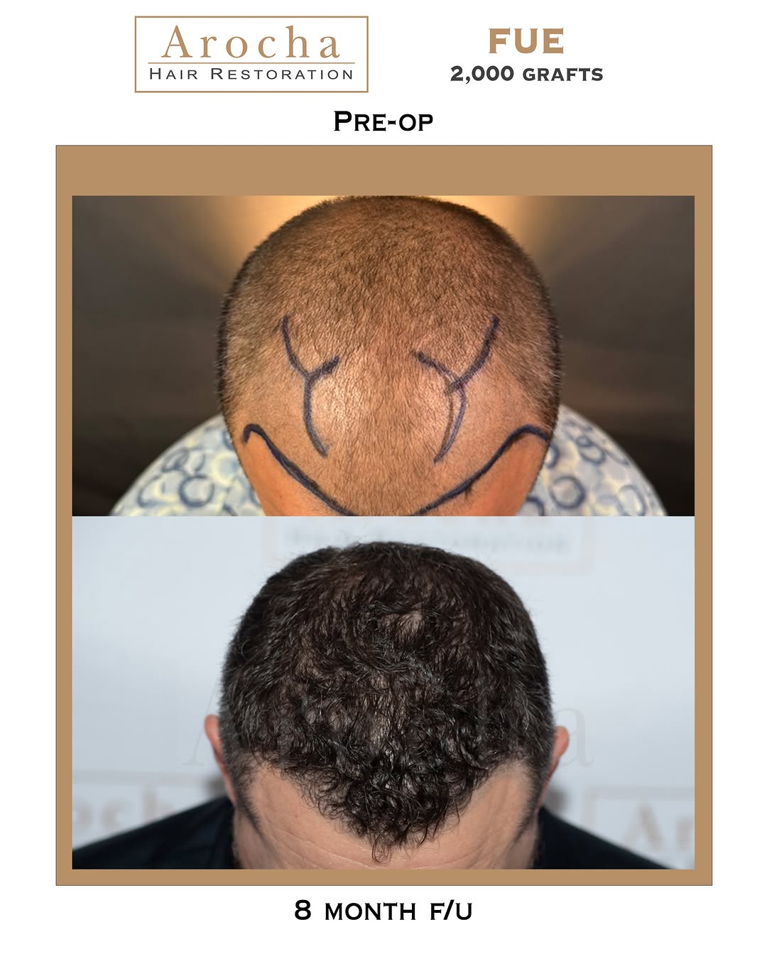 Instagram post by Dr. Bernardino Arocha: This patient came to Dr. Arocha several years ago to address the thinning he was experiencing in his frontal third - and had also undergone …